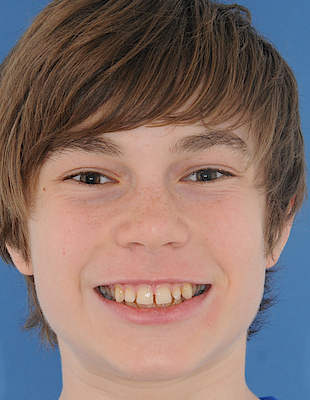 Philipp's Zahnspange vorher