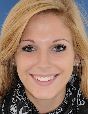 Bettina's Zahnspange nachher