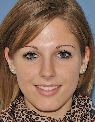 Bettina's Zahnspange vorher